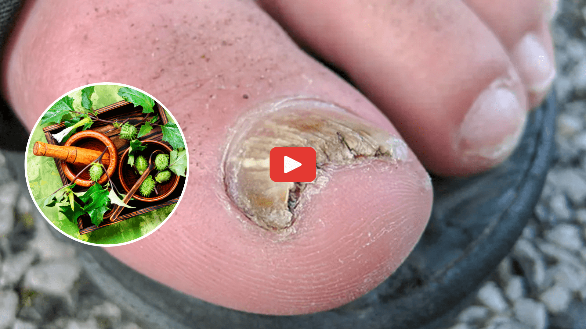 remove nail fungus video cover